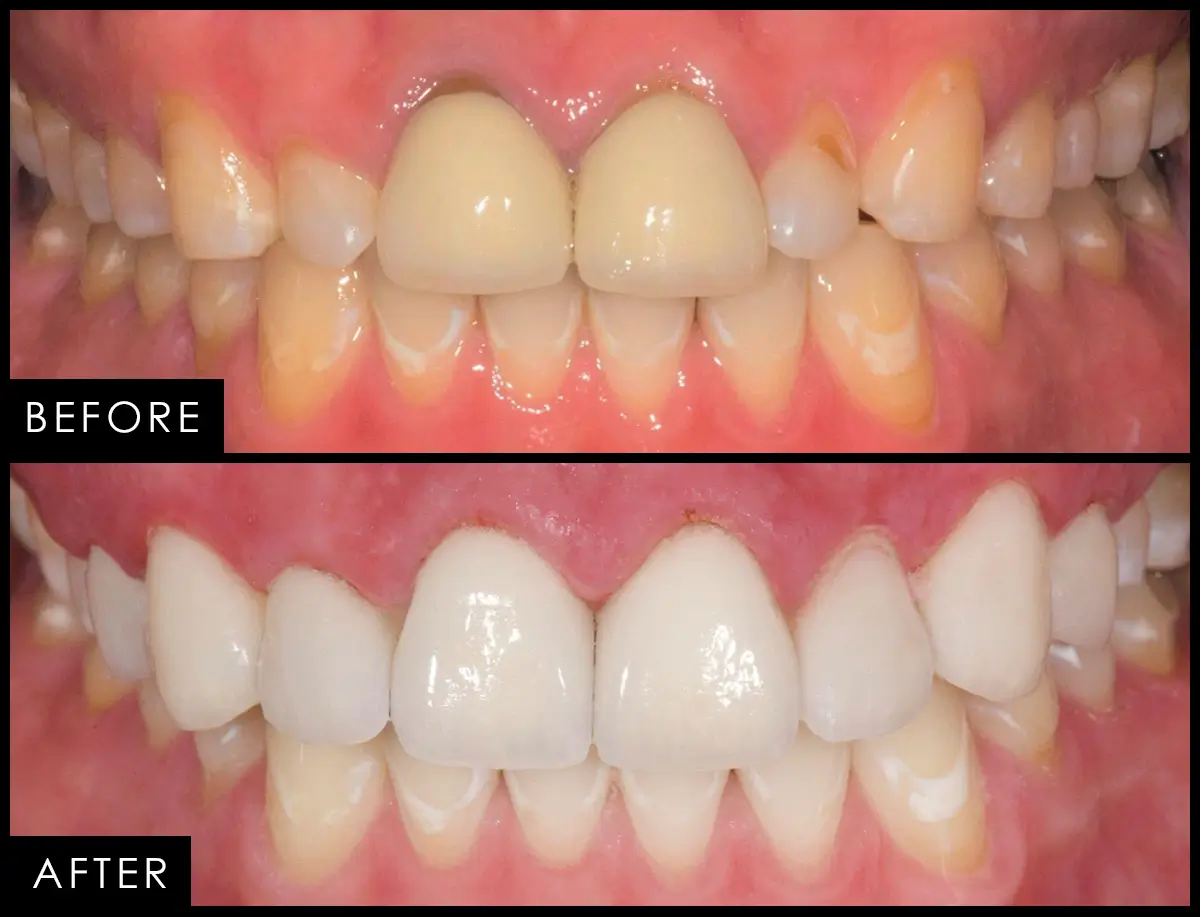 Patient case 01, before and after
