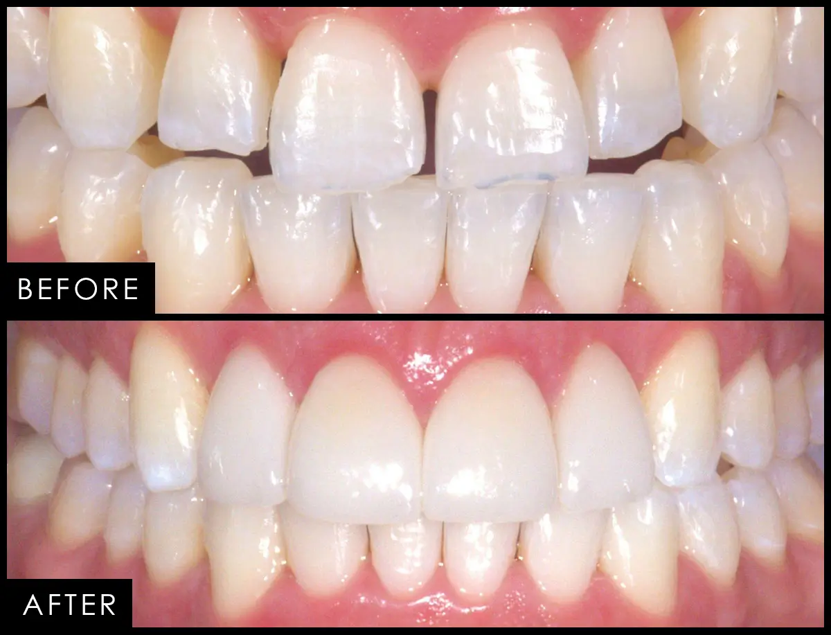 Patient case 02, before and after