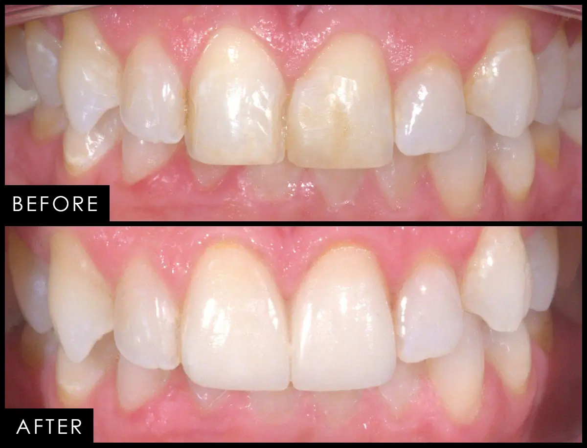 Patient case 03, before and after