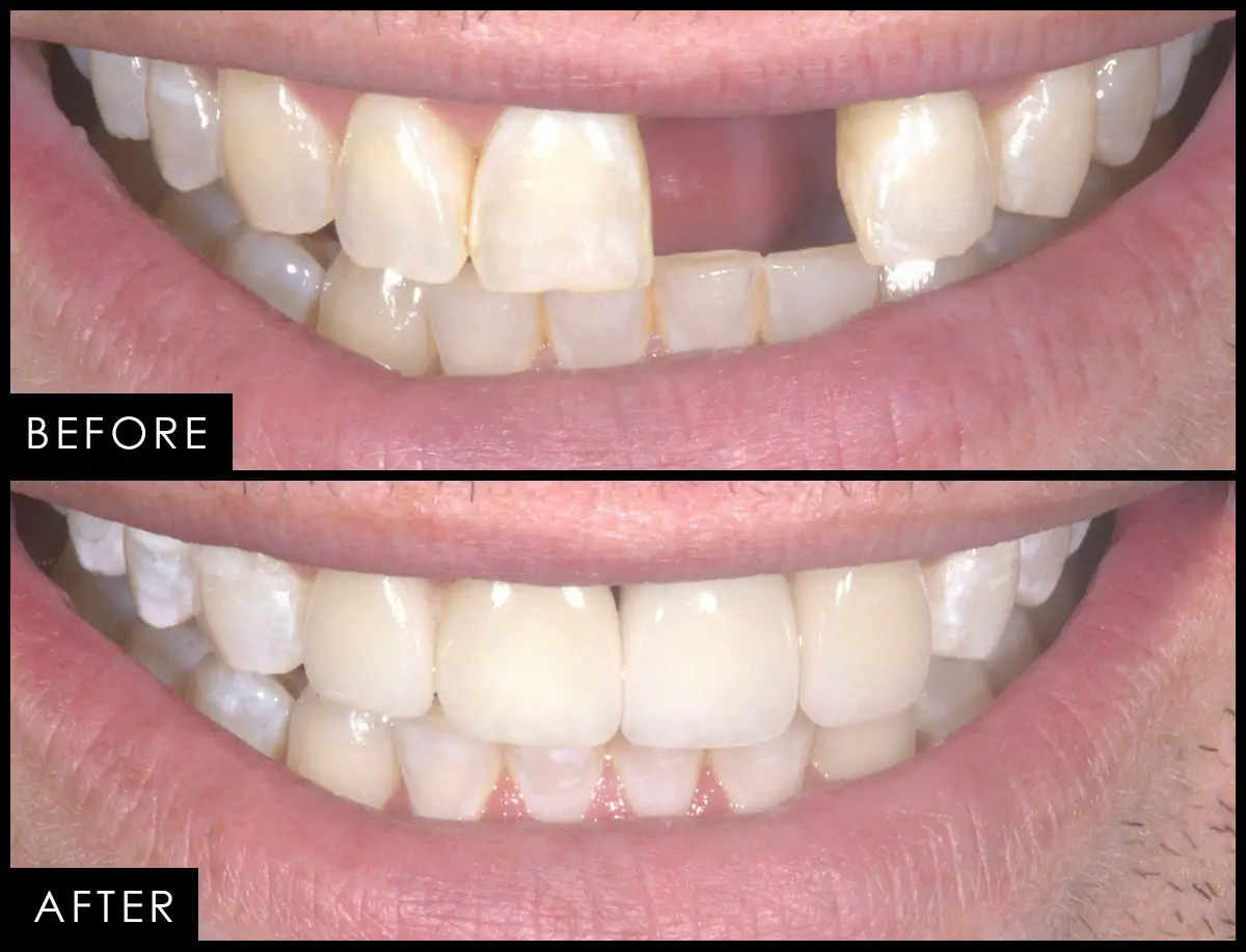 Patient case 04, before and after