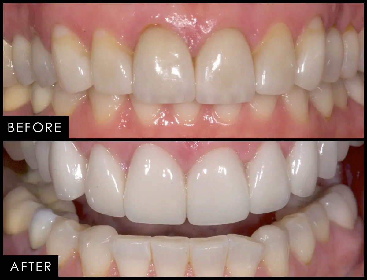 Patient case 05, before and after