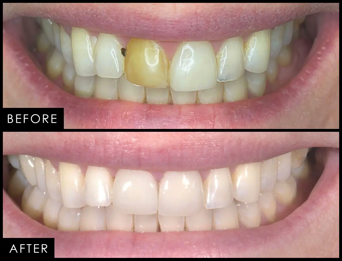 Patient case 06, before and after