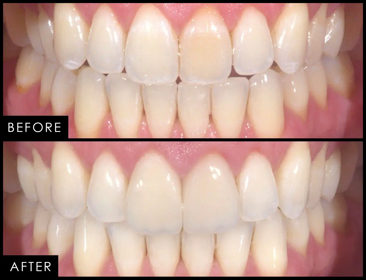 Patient case 08, before and after